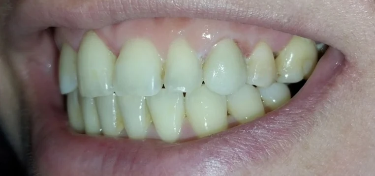 Resultado después — rehabilitación con corona